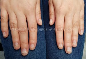 Znaczne skrócenie paznokci, poprawi skuteczność działania Onygenu