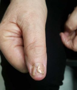 Uszkodzony paznokieć - uraz 15 lat temu