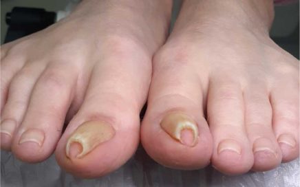 Problem z paznokciami wkręcającymi