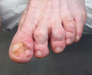 Pacjenci czasów COVID 19. Po zabiegu obcięcia i oszlifowania paznokci lewej stopy