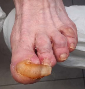 Pacjenci czasów COVID 19. Przed zabiegiem obcięcia i oszlifowania paznokci lewej stopy.